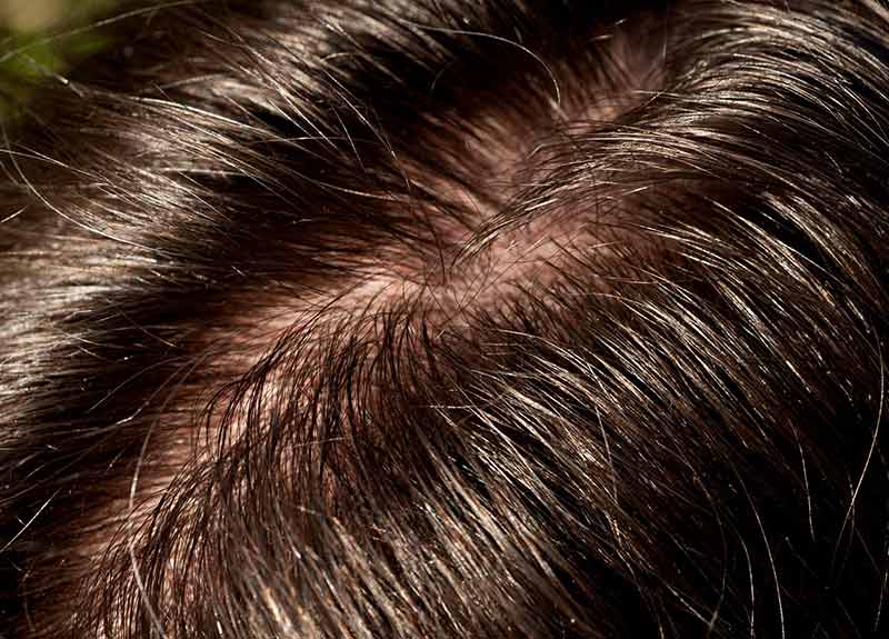 Da đầu dầu nhưng tóc lại khô – chăm sóc sao cho đúng?